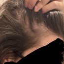 담양약국 | 담양탈모병원 미녹시딜 후기 확인해봐요