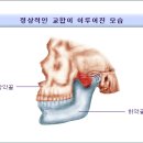 부정교합 이미지