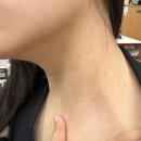 (주)성지여행 | 편사 후기 4탄 서울 편사 성지에서 편평사마귀 얼굴 목 제거 한 달부터 3개월 후기