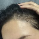 눈이랑안경 | 30대초반.. 본터널링 이마거상 그리고 눈재수술 뒷밑트임 재수술 3주차 찐 후기 -2