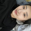 보조개 | 보조개 수술 후기 2