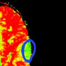 뇌혈관 MRI 이미지