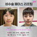 쥬베룩과 히알루론산 필러로 남자 아이돌 따라잡기, 동안 리프팅 잘하는 스카이쁘아뜨