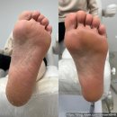 레푸스칠곡점앤 네일비치 | 부산 무좀 내성발톱 발각질 전문케어 풋샵 문제성발 특수관리 전문 레푸스 수영점앤바바네일 후기