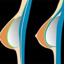 박진석성형외과의원 | 근막하가슴성형으로 자연스러운 움직임을 얻을 수 있습니다.