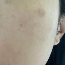 한*한 - 미추홀구 독배로473번길 12 | 쥬베룩 스킨부스터 1차,2차 내돈내산 한달후기 효과와 부작용