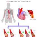 급성 심근경색증 이미지