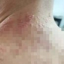 J.Med(제이메드) | 목디스크 치료방법 드디어 탈출했습니다