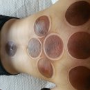 힐링쑥뜸 티스토리
