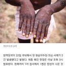 &#34;식당서 스쳐도 감염되나, 치료법은?&#34;..원숭이두창 A to Z 이미지