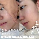 상동프라자약국 | [경기/부천] ‘뷰티포톤피아’ 하이푸 V라인 윤곽 리프팅 관리후기