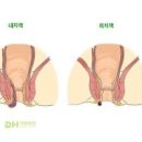 항문질환 종류 증상 그리고 왜 여름철에 자주 발생하는지에 대한 이유 이미지