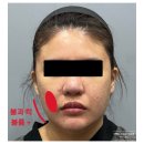 부기1 | 안면거상술 후기 1개월 차 부기