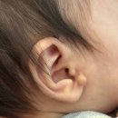 미와건강성형외과의원 | [강남 지디에스성형외과](생후 57일 아기 귀 스킨텍 제거 수술 후기)
