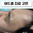 리멤버피부과의원 | 내돈내산 여드름고민 스케일링 2회차 리멤버피부과 후기