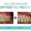 시린 치아의 원인 중 하나는 바로 치경부마모증! 이미지