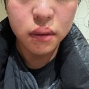 (주)코리아나화장품 | [과천피부관리 전문]과천세레니끄에서 써마리프팅과 블랙헤드 관리받은 솔직 후기