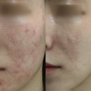 파인약품(주) | 레이저 울트라펄스앙코르 CPG 포함한 뉴에어프락셀 후기! 흉터조각술/에어서브시전/피코프락셀 도트필은...