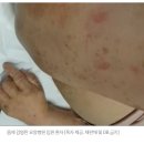 면회 금지된 요양병원서 '옴' 환자 발생.."비위생 탓" 호소 이미지