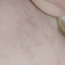 오투피부과의원 | 토리소아과 아토피 5개월 아기