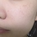 김정문알로에신경산지부 | [다이소] 토닝 후 모낭염 올라와서 써본 김정문 알로에,어퓨 티트리 스팟 세럼,클렌징 밀크 후기
