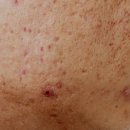 오롯의원 | 흑석동피부과 추천 네오빔레이저, 트라이앵글필링 여드름케어 후기!