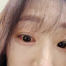 사직천안종합약국 | 순천 성모안과 포도막염 3주 치료 후기(현재진행형) + 고흥종합병원 류마티스 검사신청