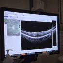 분당구미안경 | 분당 안과 방문후기 망막전막증 분당서울대병원 김민석 교수님 진료기록