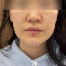 400 | 부산 덕천동 울쎄라피 프라임 400샷 내돈내산 한달후기