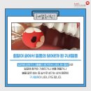 혀에 검은 점이 생겼다면? - 구내혈종 이미지