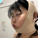 안강제일의원 | 결혼준비하기전 이중턱지방흡입을 한 3주차 후기