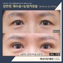 눈밑주름제거 / 중년눈성형후기 / 상안검수술병원추천 / 상안검수술직후 / 강남눈성형잘하는병원 / 이미지