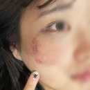 낙타정형외과의원 | 몽골여행 낙타 낙상 사고 안면 타박상 후기