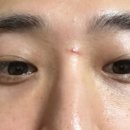 강한피부과의원 네이버블로그