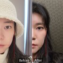 편한자리의원 | 선정릉역 피부과 루피엘의원 리니어지 리프팅 시술 600샷 통증 및 한달 후기