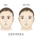 양안격리증[Hypertelorism] 이미지