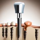광주 서구 임플란트 치과 가격 싼곳,저렴한곳,잘하는곳 추천 BEST10