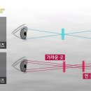 백내장수술의 불편한 진실(소비자리포트 2017-2-17) 이미지