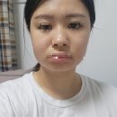 독도PC방 | 2023년 05월_매복사랑니 4개 동시발치 후기