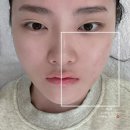 강남역 신논현 갤러리 피부과 기미잡티제거 피코토닝 레이저 피부과 비타민관리 후기