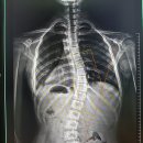 연세보조기 이미지