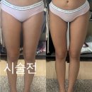 보타리에너지(주) | 일산 두달차 허벅지지방추출주사 리얼후기 총 사이즈 변화와 금액은 얼마나 나왔을까?