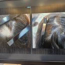 발머스한의원 | [부산] 발머스한의원 부산연산 - 원형탈모 치료 후기