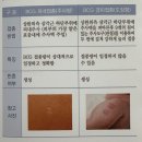 [예방 접종] BCG 피내용 vs 경피용 차이점과 영등포구 윤민소아과 접종 후기