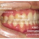 키노인터네셔널치과의원 | 턱이 나오는 거 같아요