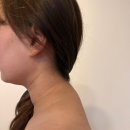 힐링미한의원 | 아산 배방에스테틱 바른미피부관리실 MTS 특수관리 후기