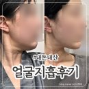 얼굴 | [성형] 얼굴지흡후기 :: 당일~ 일주일 (내돈내산)