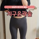 서초엘산부인과의원 | Y존 부각 돌출, 강남역 산부인과 히어산부인과 치구윤곽술로 매끈해진 후기