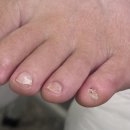 레푸스 상도점 | 노원 네일러그 레푸스 노원역점 발톱무좀초기 발톱관리 스케일링 만족후기