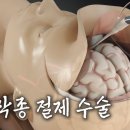 충격적인 뇌수막종 수술 방법 이미지